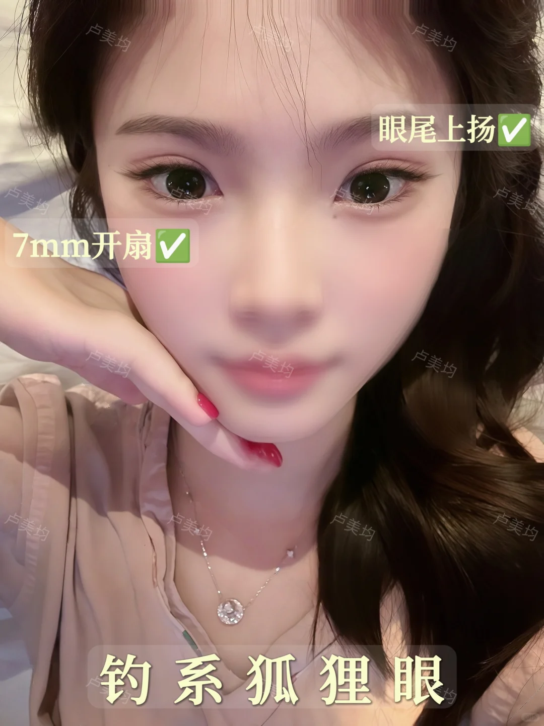 重庆双眼皮｜标准的7mm开扇钓系狐狸眼！
