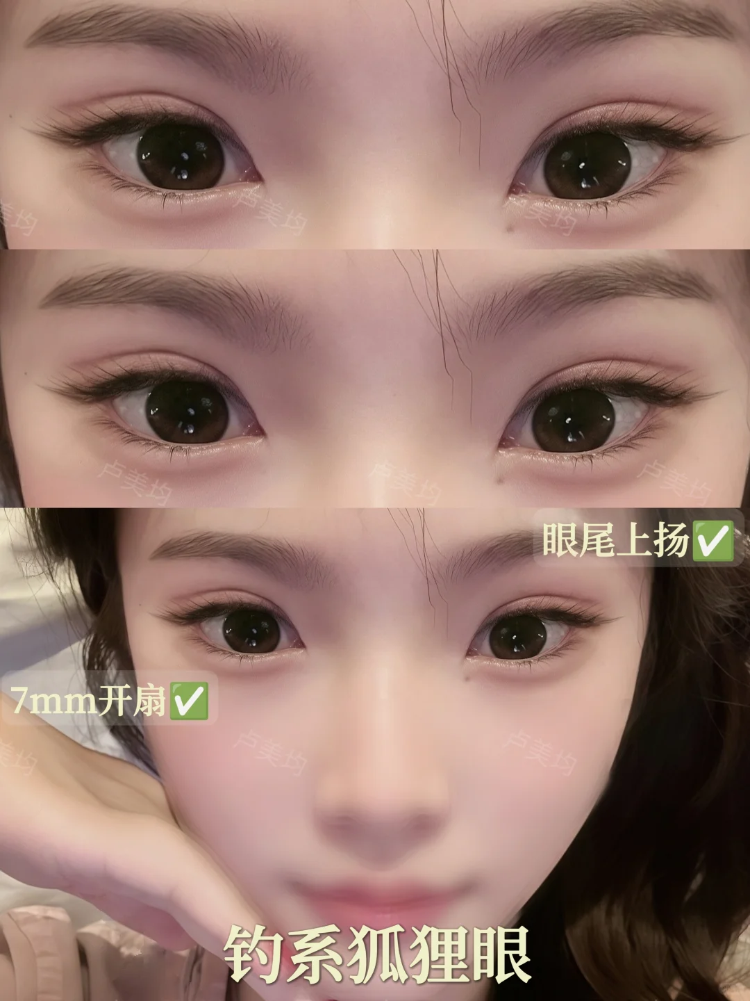 重庆双眼皮｜标准的7mm开扇钓系狐狸眼！